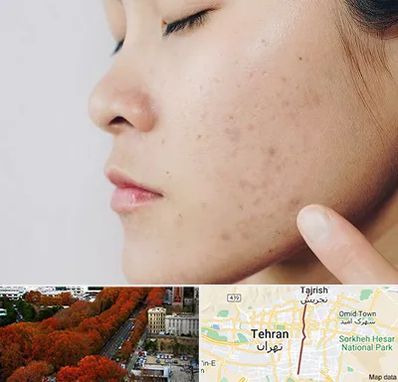 دکتر جوش صورت در ولیعصر 