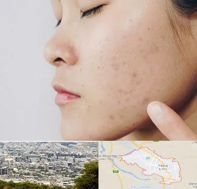 دکتر جوش صورت در یاسوج