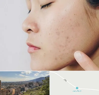 دکتر جوش صورت در بوکان تهران