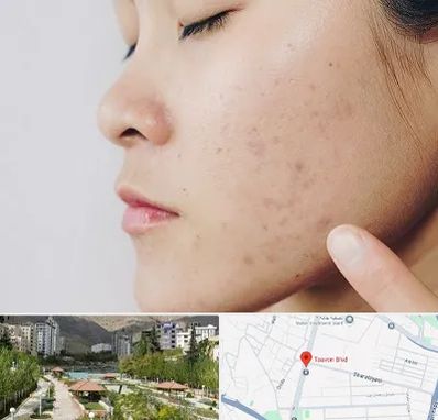 دکتر جوش صورت در بلوار تعاون