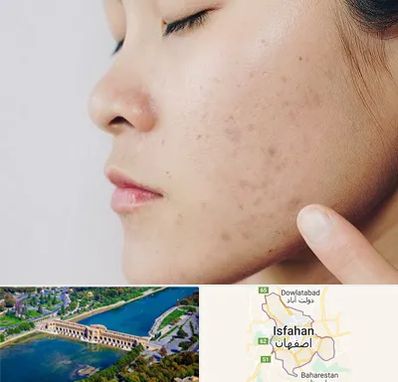 دکتر جوش صورت در اصفهان