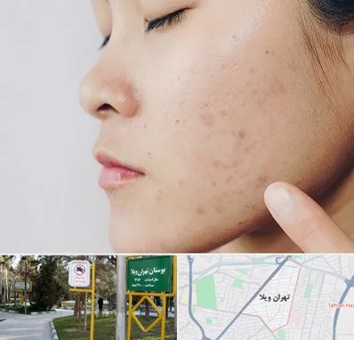 دکتر جوش صورت در تهران ویلا