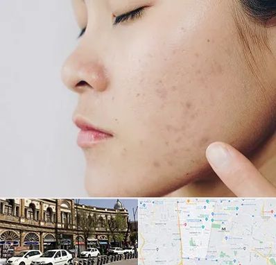 دکتر جوش صورت در منطقه 11 تهران