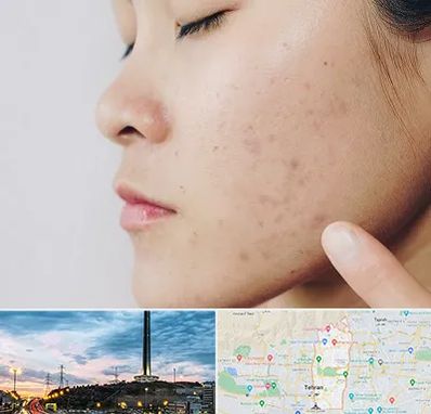 دکتر جوش صورت در منطقه 2 تهران