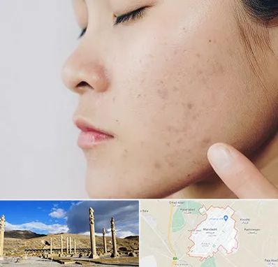 دکتر جوش صورت در مرودشت