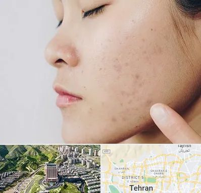 دکتر جوش صورت در شمال تهران 