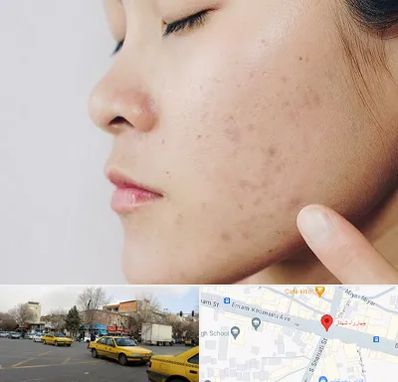 دکتر جوش صورت در شهناز تبریز