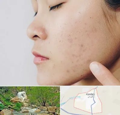 دکتر جوش صورت در کردان