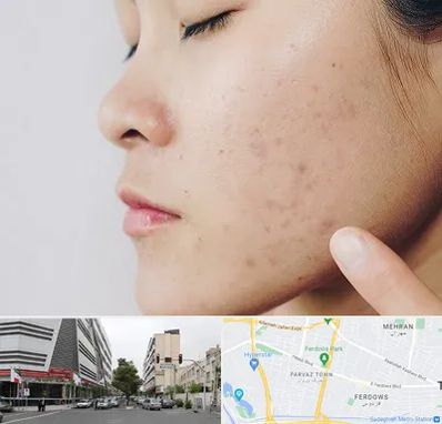 دکتر جوش صورت در بلوار فردوس 