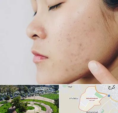 دکتر جوش صورت در مهرشهر کرج 