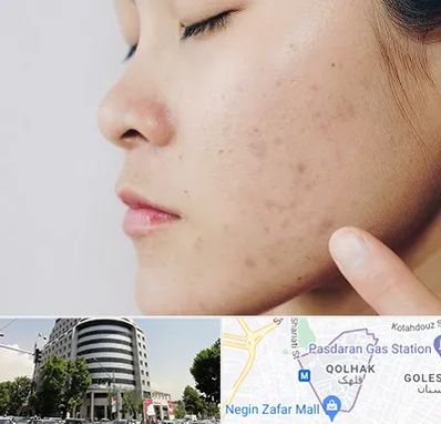 دکتر جوش صورت در قلهک 