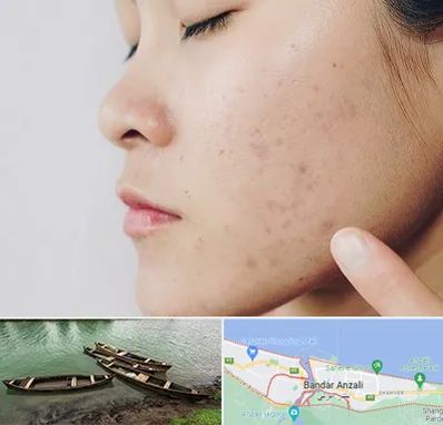 دکتر جوش صورت در بندر انزلی