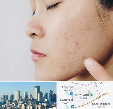 دکتر جوش صورت در قیطریه 