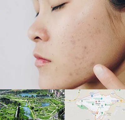 دکتر جوش صورت در بجنورد