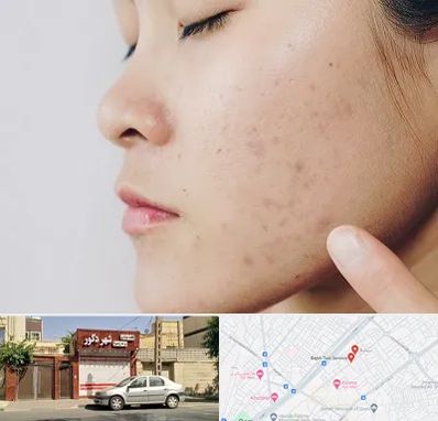 دکتر جوش صورت در باجک قم