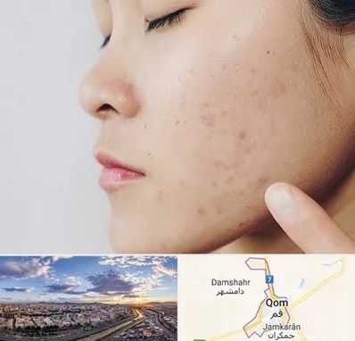 دکتر جوش صورت در قم