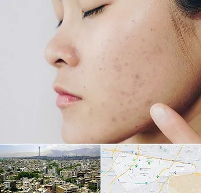 دکتر جوش صورت در منطقه 8 تهران