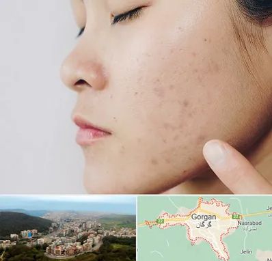 دکتر جوش صورت در گرگان