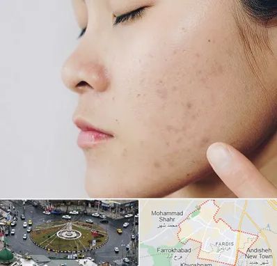 دکتر جوش صورت در فردیس کرج 