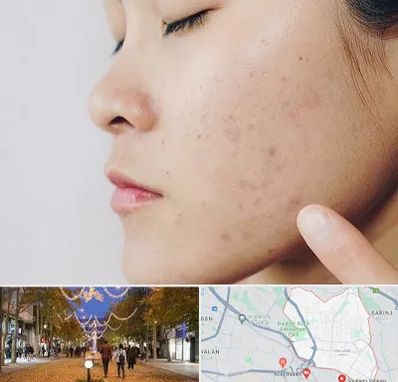 دکتر جوش صورت در ولیعصر ارومیه