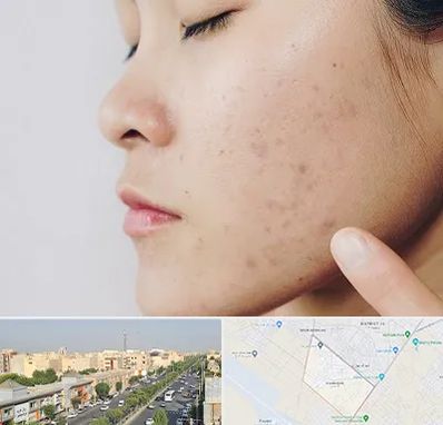 دکتر جوش صورت در کیانمهر کرج