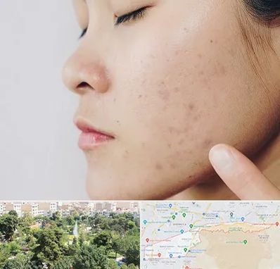 دکتر جوش صورت در منطقه 13 تهران