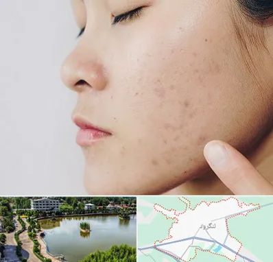 دکتر جوش صورت در لنگرود