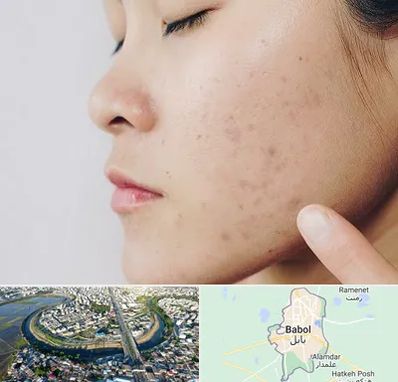 دکتر جوش صورت در بابل