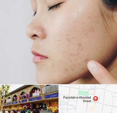 دکتر جوش صورت در 15 خرداد