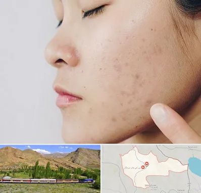 دکتر جوش صورت در خاش