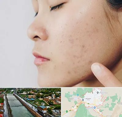 دکتر جوش صورت در مراغه