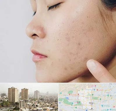 دکتر جوش صورت در منطقه 5 تهران