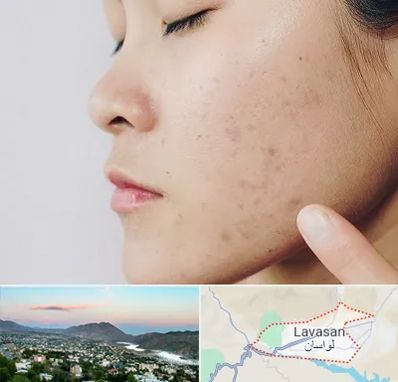 دکتر جوش صورت در لواسان