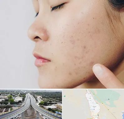 دکتر جوش صورت در اندیمشک