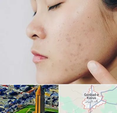 دکتر جوش صورت در گنبد کاووس