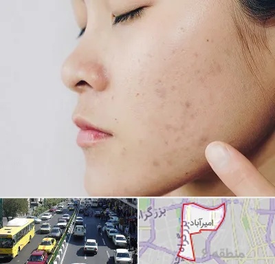 دکتر جوش صورت در امیرآباد