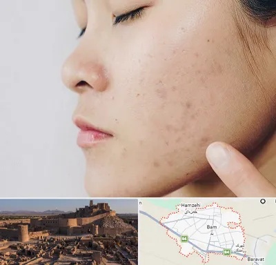 دکتر جوش صورت در بم