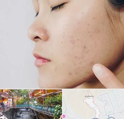 دکتر جوش صورت در درکه