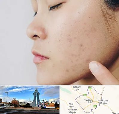 دکتر جوش صورت در تایباد