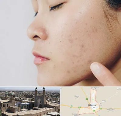 دکتر جوش صورت در سبزوار