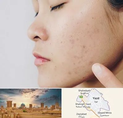 دکتر جوش صورت در یزد