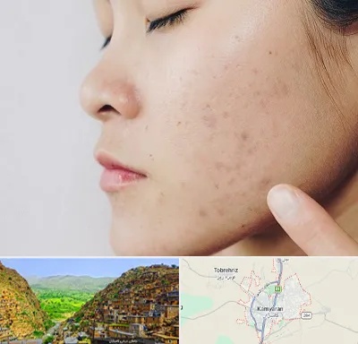 دکتر جوش صورت در کامیاران