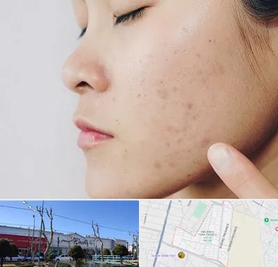 دکتر جوش صورت در فاز دو اندیشه