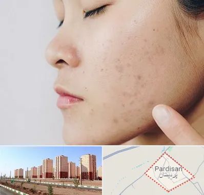 دکتر جوش صورت در پردیسان قم