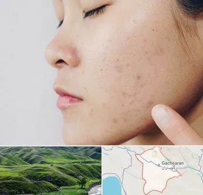 دکتر جوش صورت در گچساران