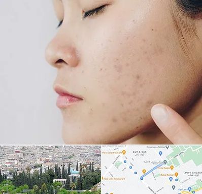 دکتر جوش صورت در محلاتی شیراز