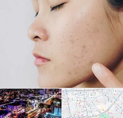 دکتر جوش صورت در منظریه رشت