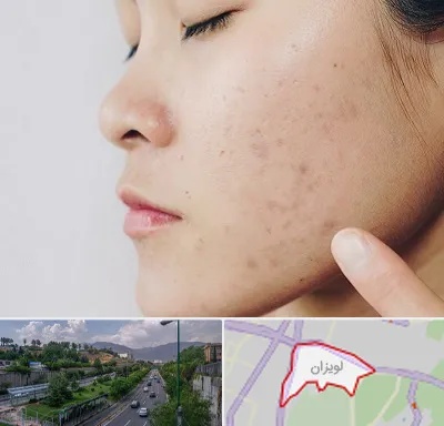 دکتر جوش صورت در لویزان