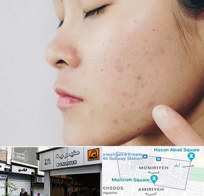 دکتر جوش صورت در منیریه 