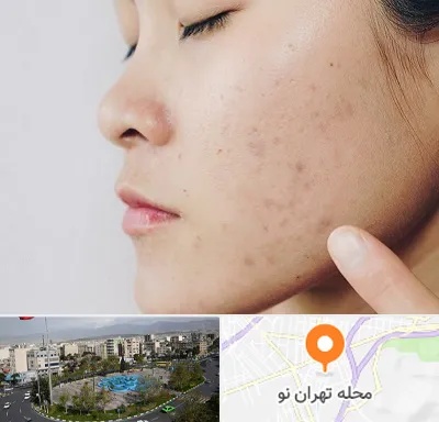 دکتر جوش صورت در تهران نو